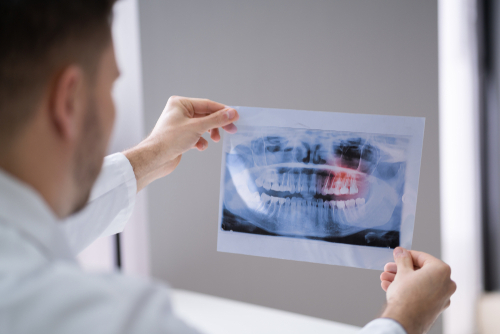 Diagnostic d'un abcès dentaire chronique à Paris sur une radiographie 3D (CBCT).