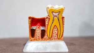 Pose sécurisée d'une couronne sur dent dévitalisée à Paris avec protocole adhésif.