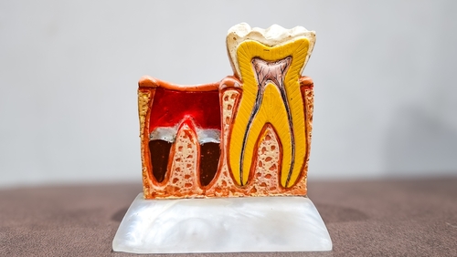 Pose sécurisée d'une couronne sur dent dévitalisée à Paris avec protocole adhésif.