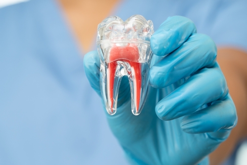 Explication d'une reprise endodontique à Paris pour éviter l'extraction dentaire.